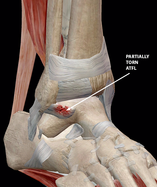 sports-injuries-grade-2-ankle-sprain